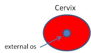 What are some causes of stenotic cervix?